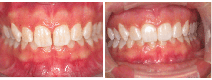 Invisalign in Sandy Springs, Georgia before and after