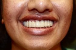 After snap on smile for damaged teeth