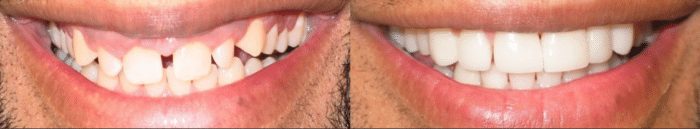 Real Results With Porcelain Veneers