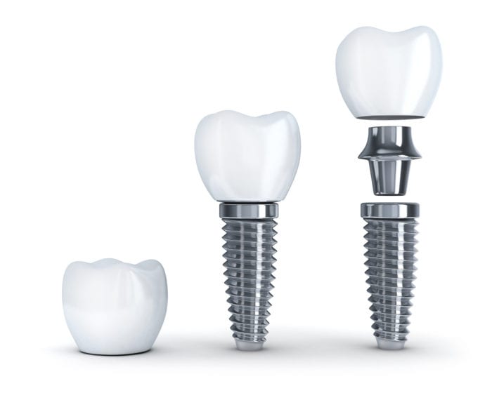 single dental implant sandy springs ga