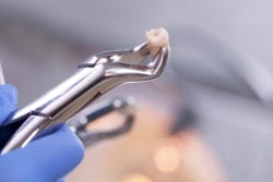 tooth extraction sandy springs georgia dentist