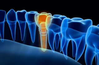 prevent dental implant failure