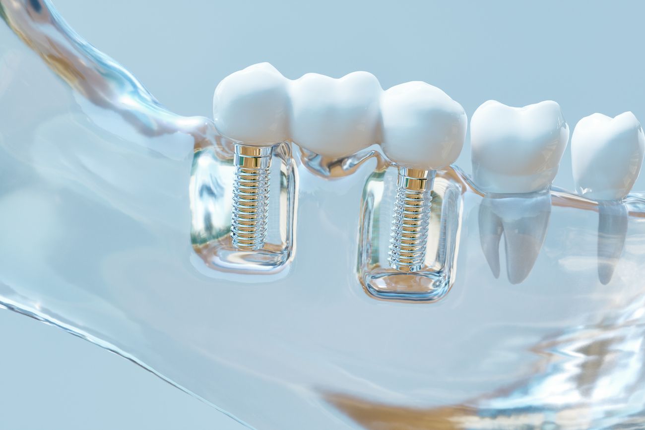 Discover Dental Implant Durability